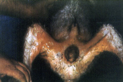 Рисунок 2. Выраженные симметричные кожные поражения в виде участков экссудации, эритемы, эрозии и облысения на внутренней поверхности бедер, в промежности и на животе, связанные с МНЭ неустановленного типа, у метиса.