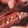 Зубной камень и болезни периодонта