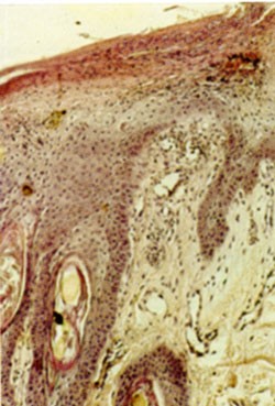 Рисунок 5. Гистологическая картина кожного образца при МНЭ: паракератоидный гиперкератоз, эдема и акантоз в верхних слоях эпидермиса, гиперпластические изменения в базальных слоях. Образец получен у той же собаки, что показана на Рисунке 2. Заметны чередующиеся полосы красного, белого и синего цветов в эпидермисе, а также признаки поверхностного периваскулярного дерматита. Увеличение х100, окрашивание гематоксилинэозином. 